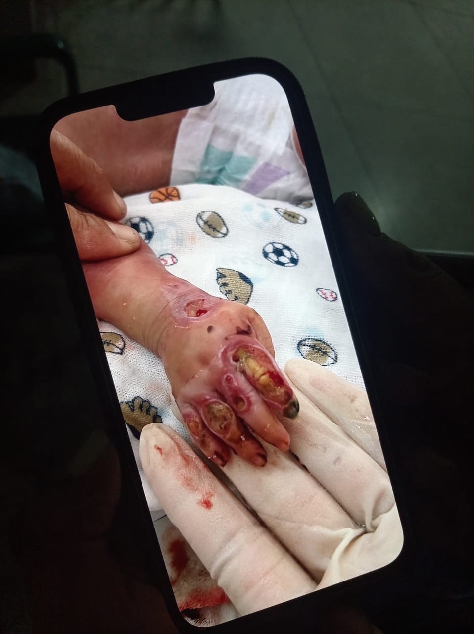 CASO DEL NEONATO QUEMADO EN BARINAS: DICTAN PRIVATIVA DE LIBERTAD CONTRA CINCO TRABAJADORES DE LA SALUD